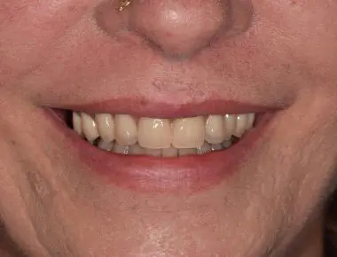 Les dents de Virgine après les soins