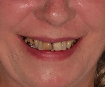 Les dents de Virgine avant les soins